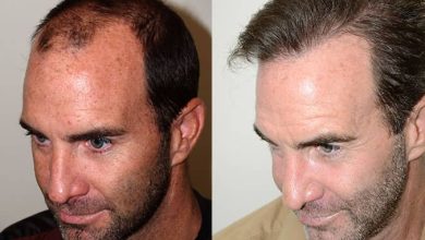 Hair Transplants