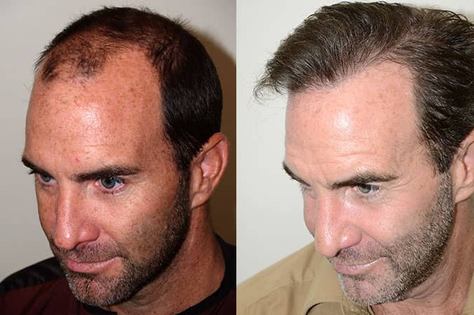 Hair Transplants