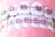 Metal Braces: Transforming Smiles with Confidence
