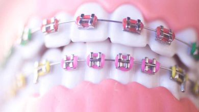 Metal Braces: Transforming Smiles with Confidence