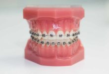 Understanding the Cost of Braces in Elmhurst: A Comprehensive Guide