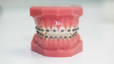 Understanding the Cost of Braces in Elmhurst: A Comprehensive Guide