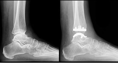 How Total Ankle Replacement Can Improve Your Quality of Life Find