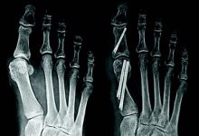 Where Can You Find Expertise in Minimally Invasive Bunion Surgery in Scottsdale, AZ