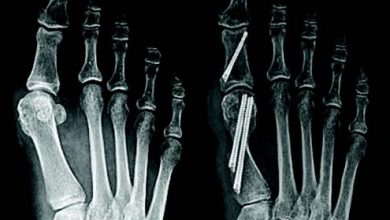 Where Can You Find Expertise in Minimally Invasive Bunion Surgery in Scottsdale, AZ