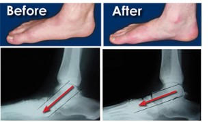 Why Choose Flatfoot Surgery at Foot and Ankle Center of Arizona