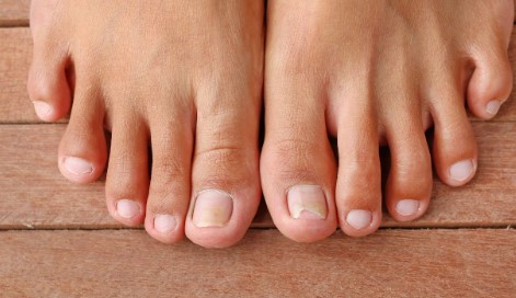 Where to Find Toe Nail Fungus Treatment in AZ