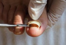 Where to Get Partial Toenail Removal in AZ