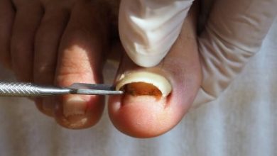 Where to Get Partial Toenail Removal in AZ