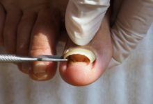Where to Get Partial Toenail Removal in AZ