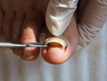 Where to Get Partial Toenail Removal in AZ