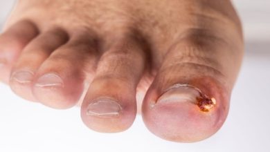 Where to Get the Best Pus Under Toenail Treatment