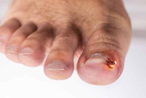 Where to Get the Best Pus Under Toenail Treatment