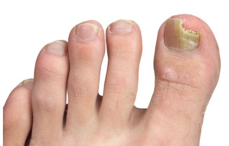 How To Heal A Toe Infection See