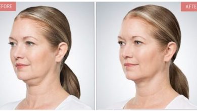 Why Do Kybella Side Effects Happen