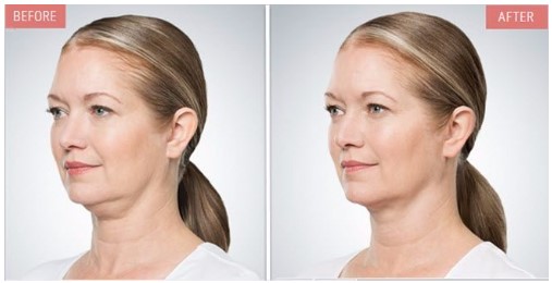 Why Do Kybella Side Effects Happen